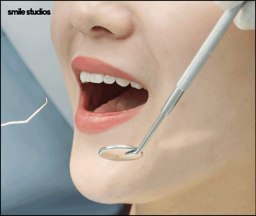 최소삭제 라미네이트 성공하려면 체크할 점 관련 이미지 6