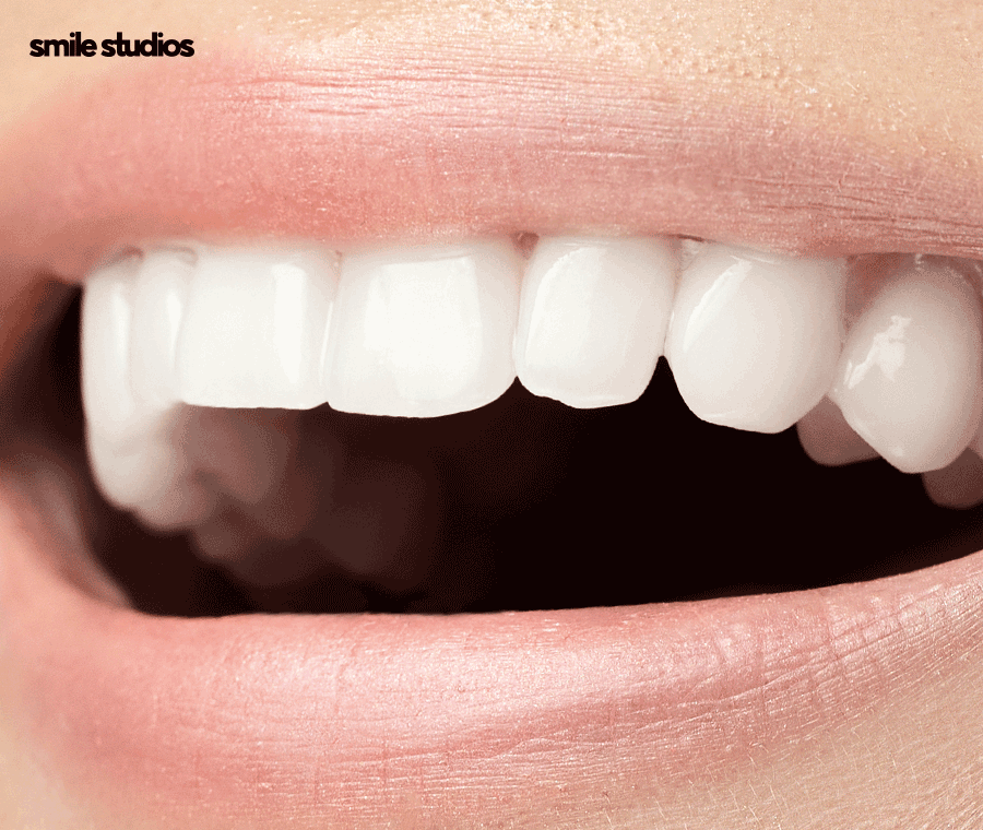 누런이빨 라미네이트 보완 효과, 미백과 차이점 관련 이미지 10
