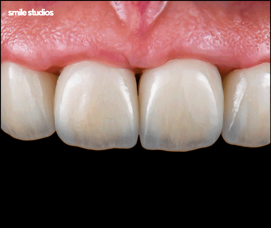 심미보철 가격, 기준, 시술 전 확인사항 총 정리 관련 이미지 9