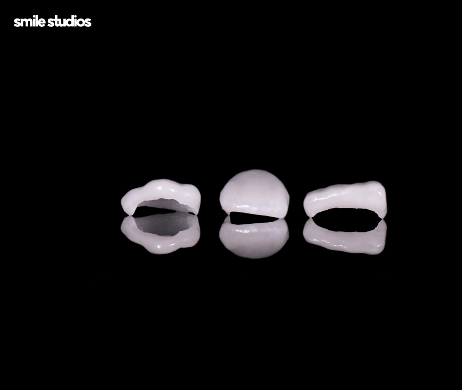 무삭제 라미네이트 효과, 원리, 선호하는 이유 A to Z 관련 이미지 8