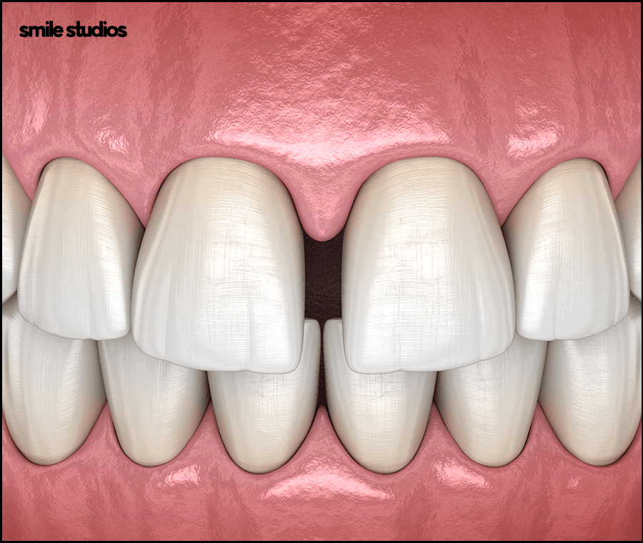Why Are Veneers Preferred for Gaps Between the Front Teeth? image 4