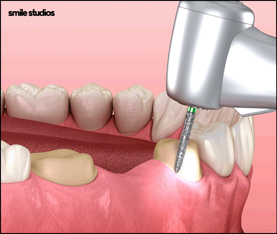 신논현역치과, 라미네이트 시술 전 꼭 확인할 핵심 2가지 관련 이미지 8