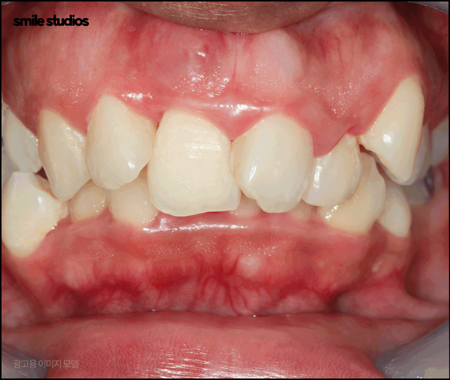 역삼역치과 인비절라인, 브라켓과 차이점 알아보기 관련 이미지 13