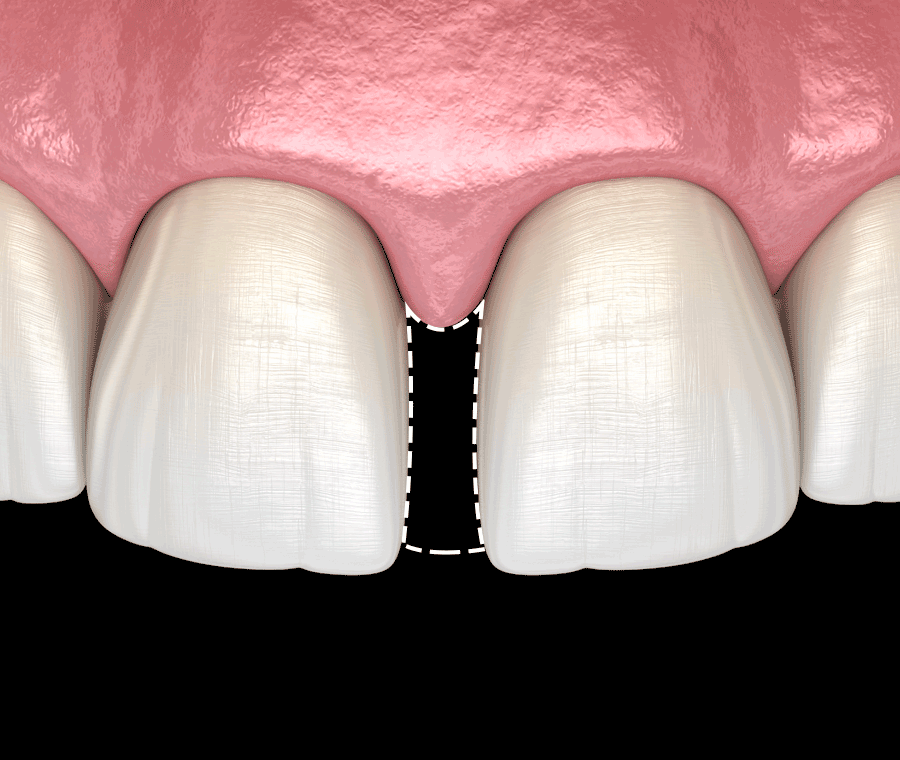 치아사이 벌어짐 가지런한 앞니 만드는 Tip 관련 이미지 2