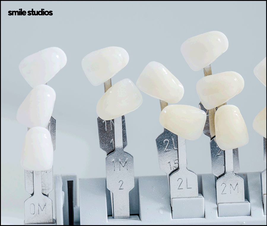 연예인라미네이트 선호도가 높은 이유, 효과 관련 이미지 3