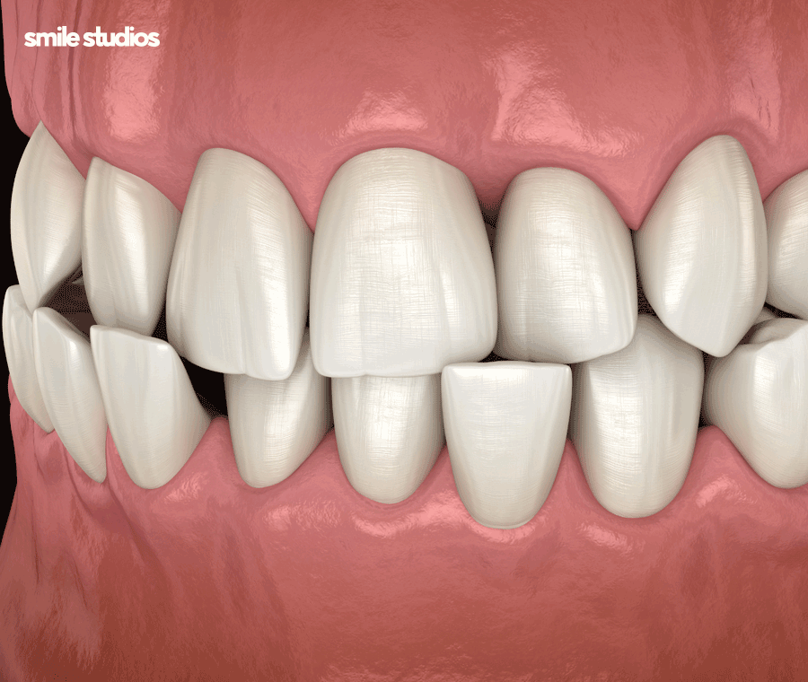 부정교합 교정기(투명) 종류 및 특징 알아보기 관련 이미지 9