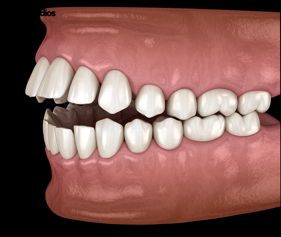 강남논현동치과 인비절라인 과정 및 개선 효과는? 관련 이미지 4