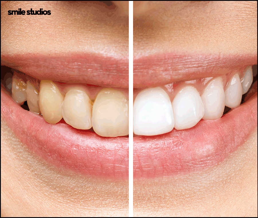 최소삭제 라미네이트 성공하려면 체크할 점 관련 이미지 4