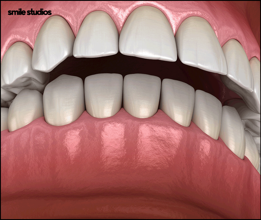 반포동 치과 돌출입 교정, 인비절라인 효과는? 관련 이미지 5