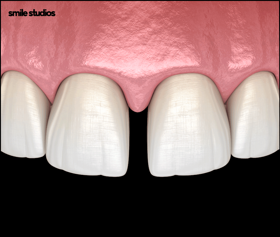 앞니무삭제라미네이트 핵심이 되는 사항은? 관련 이미지 2