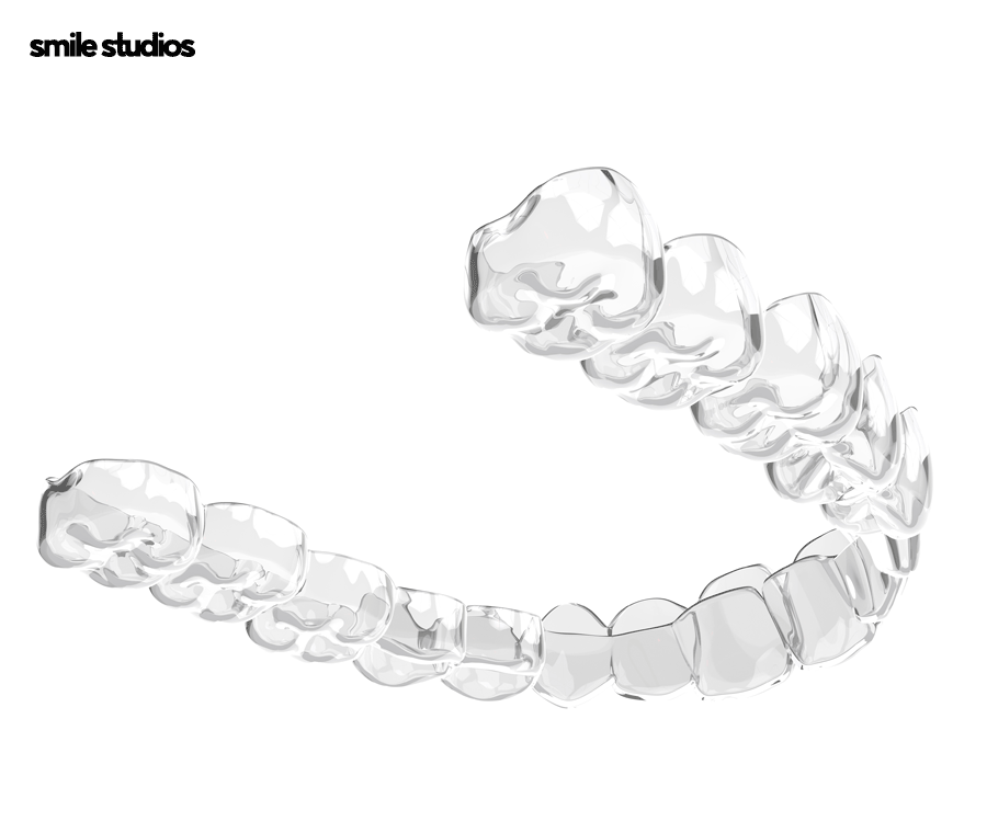 과개교합 교정을 위한 나노라이너 특징 총 정리 관련 이미지 3