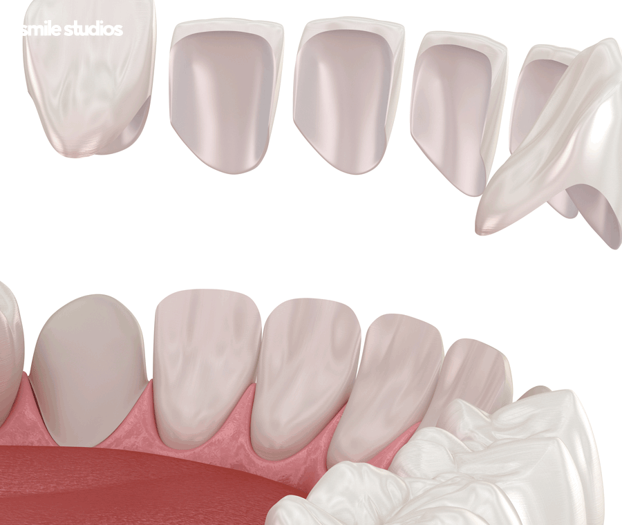 라미네이트 변색, 발생하는 이유, 시점, 대처 방법 관련 이미지 8