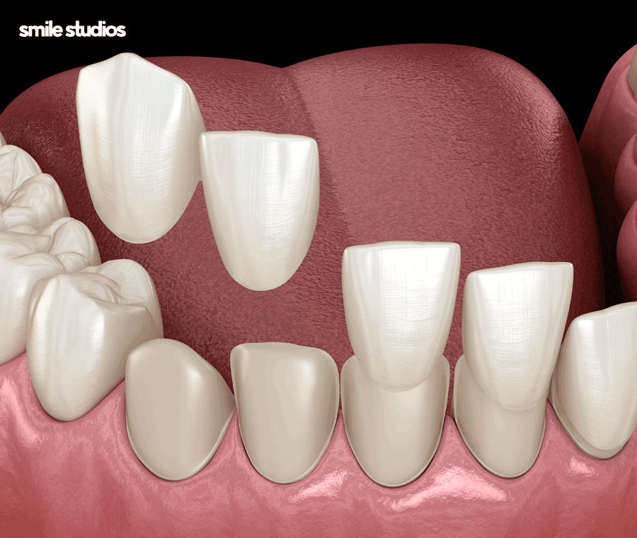 치아 사이 검은색 나타나는 이유, 회복 방법은? 관련 이미지 4