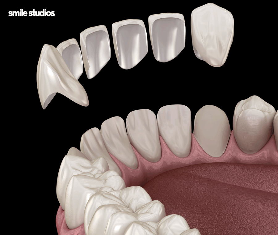 학동역치과 라미네이트 고민된다면 사전에 확인할 점 관련 이미지 4