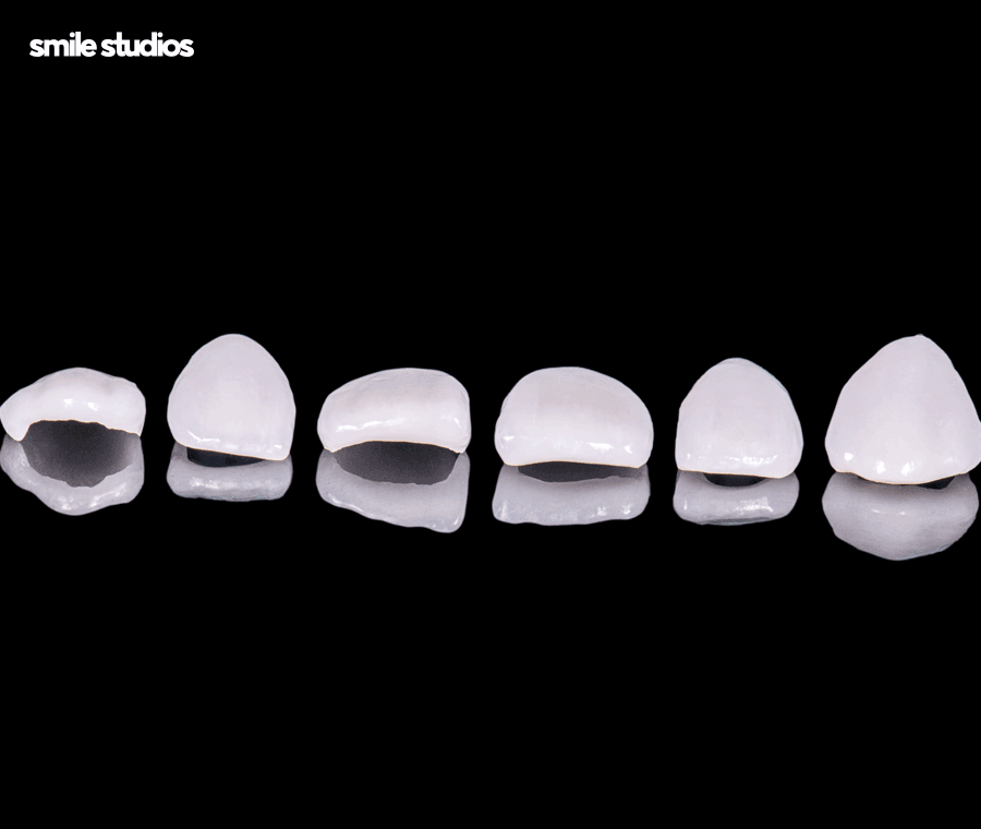 앞니 살짝 깨짐 라미네이트로 대처 가능한 수준은? 관련 이미지 7