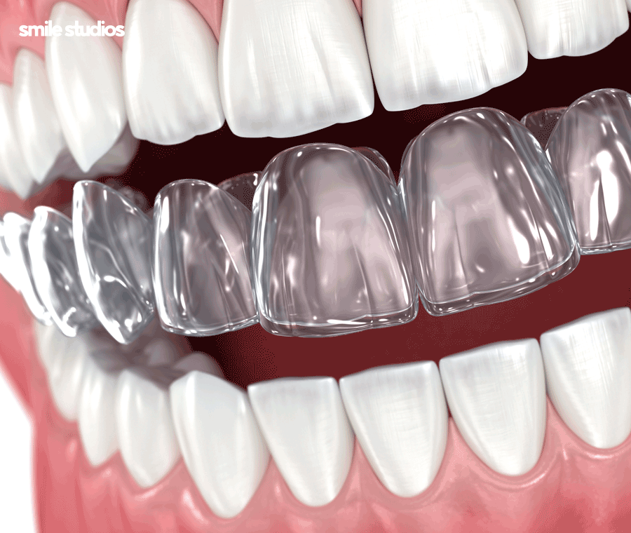 이빨교정비용 좌우하는 기준점 알아보기 관련 이미지 8