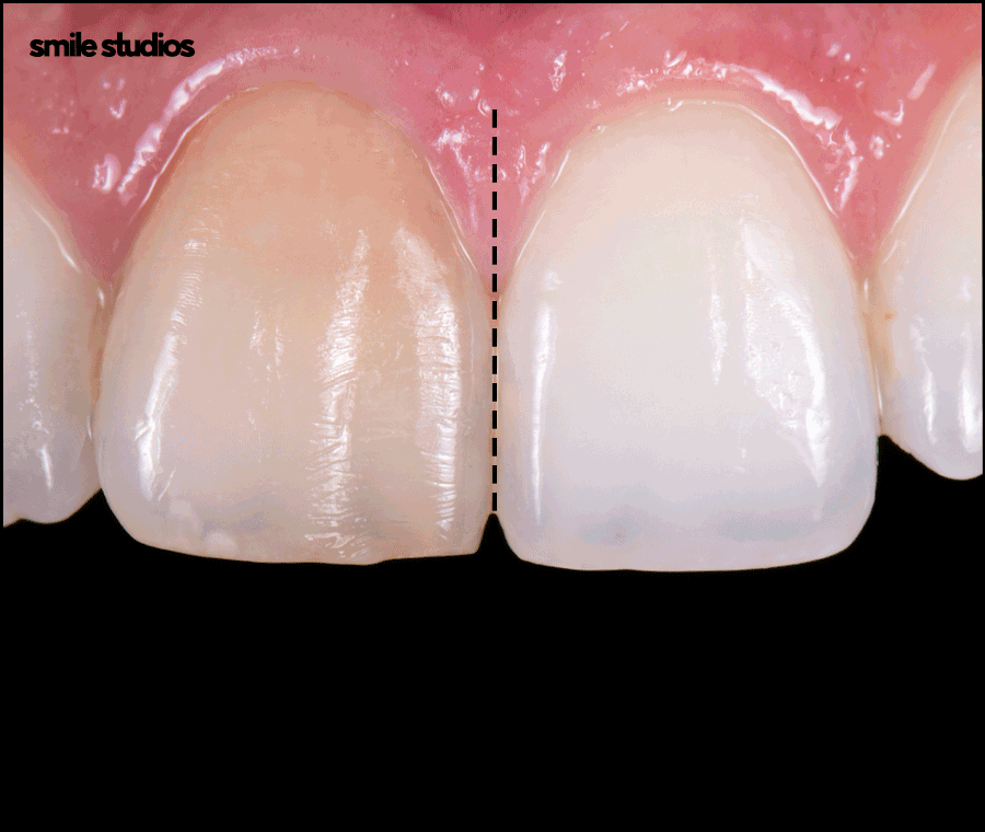 누런이빨 라미네이트 보완 효과, 미백과 차이점 관련 이미지 2