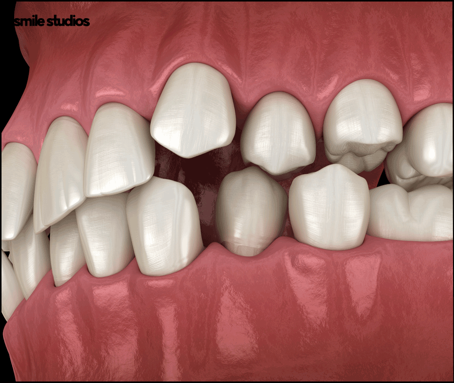 역삼역치과 인비절라인, 브라켓과 차이점 알아보기 관련 이미지 2