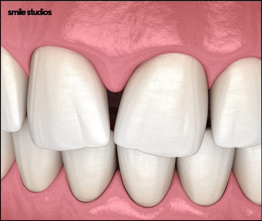 앞니 블랙트라이앵글 보완을 위한 라미네이트 효과 관련 이미지 5