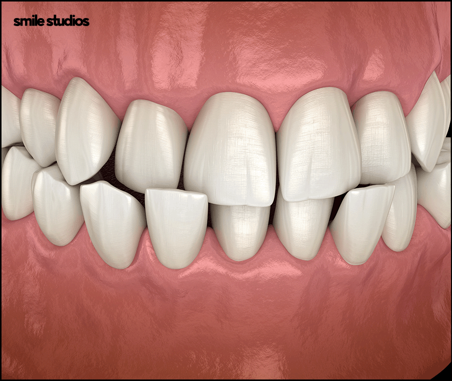 잠원동치과 투명교정 나노라이너, 인비절라인 비교 관련 이미지 8