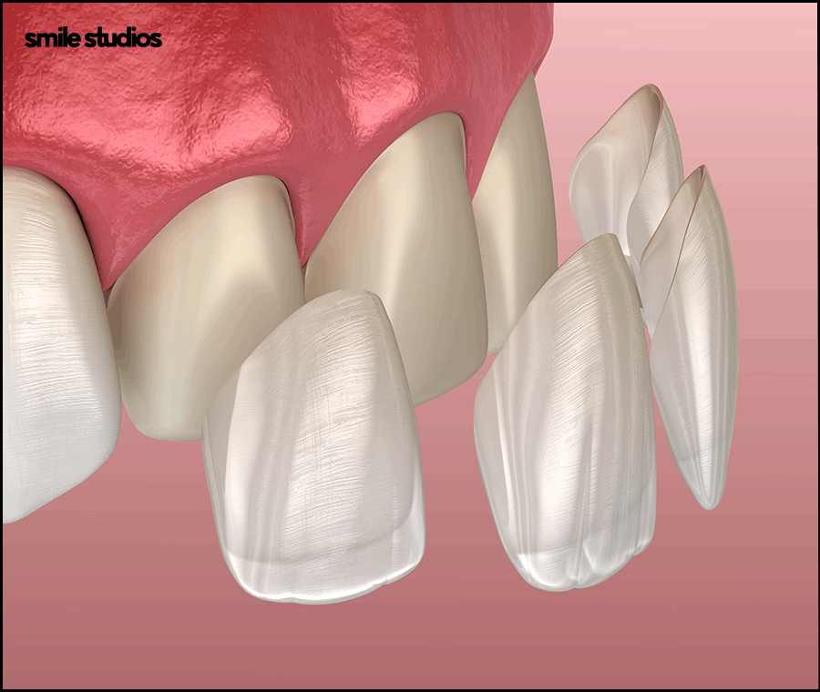 앞니 크랙 금간 치아, 빠른 수복 방법 알아보기 관련 이미지 9