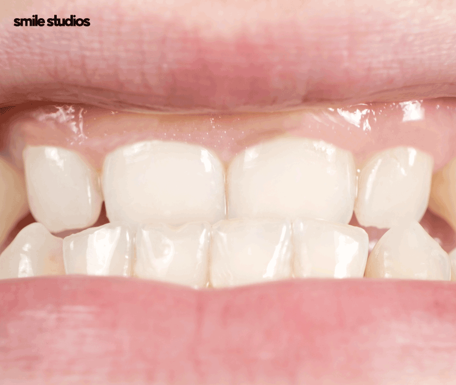 옥니 교정 필요한 이유, 발생 원인, 방법 파헤치기 관련 이미지 3