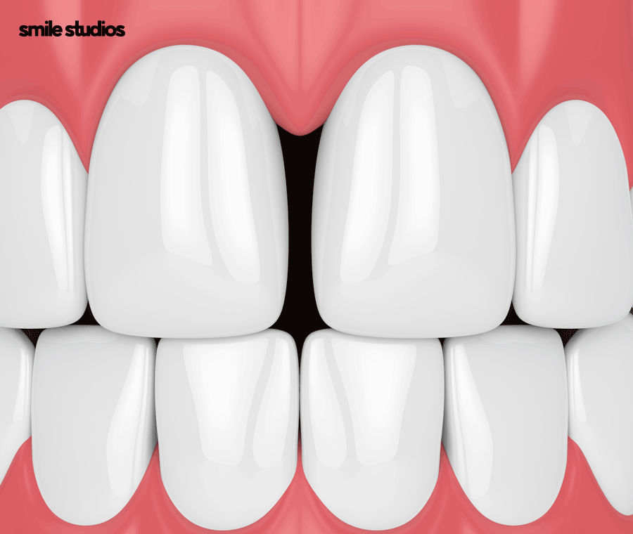 논현 라미네이트 시술 고민된다면 필수체크 관련 이미지 10