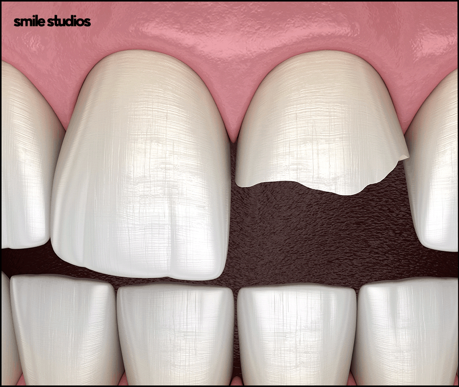 How to Restore Chipped or Fractured Front Teeth and Check the Results image 5