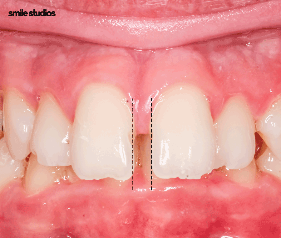 치아사이 벌어짐 가지런한 앞니 만드는 Tip 관련 이미지 3