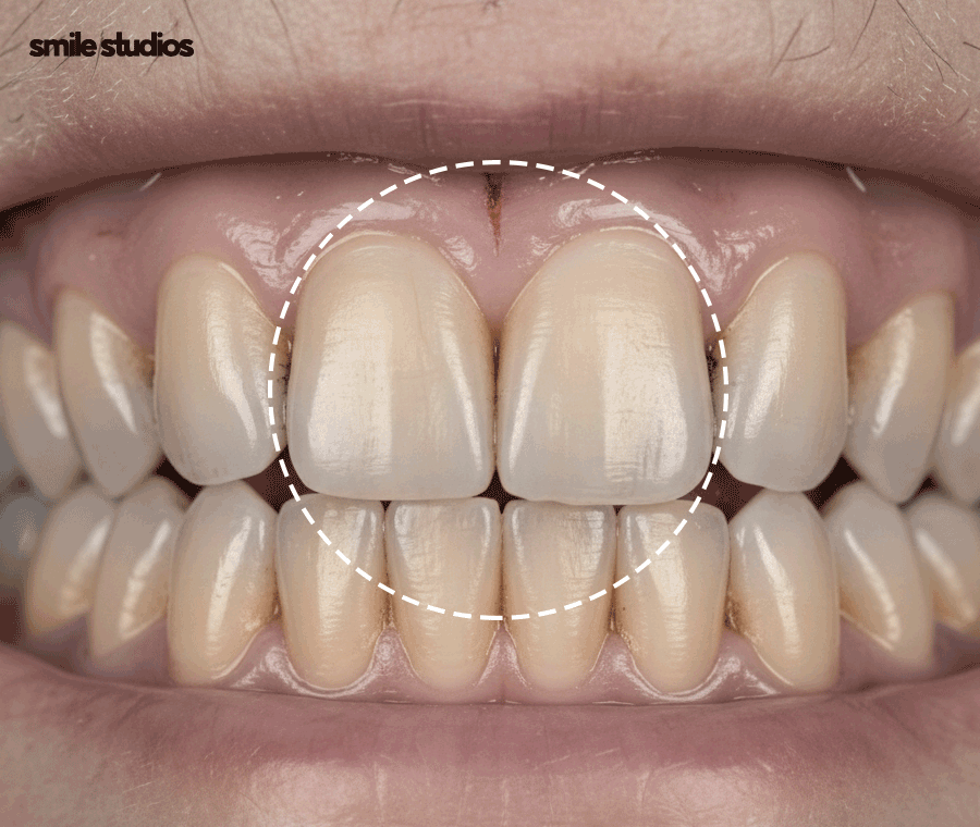 옥니 교정 필요한 이유, 발생 원인, 방법 파헤치기 관련 이미지 4