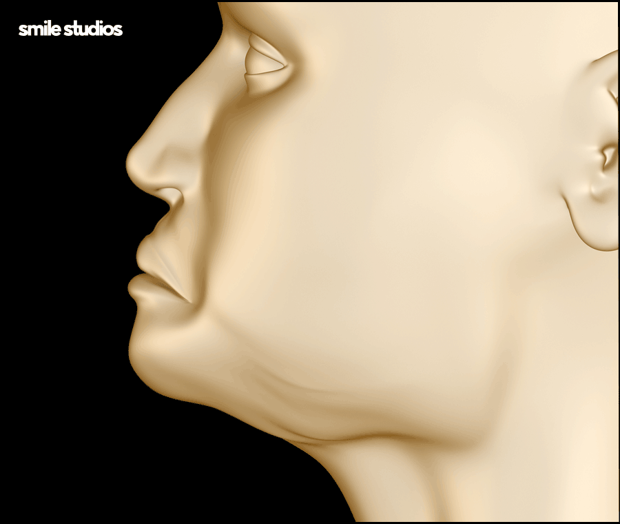 What Are the Key Points That Affect the Success of Receding-Chin Correction? image 3