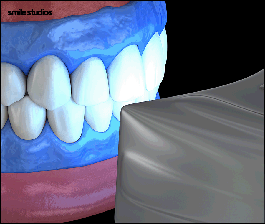 누런이빨 라미네이트 보완 효과, 미백과 차이점 관련 이미지 7