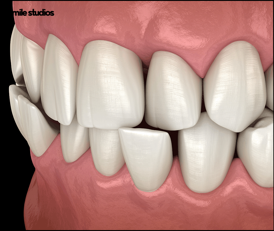 논현동 치과 인비절라인 투명교정 효과, 장/단점 관련 이미지 4