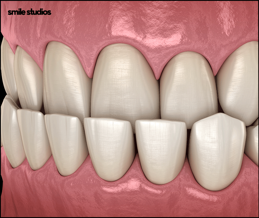 강남논현동치과 인비절라인 과정 및 개선 효과는? 관련 이미지 3