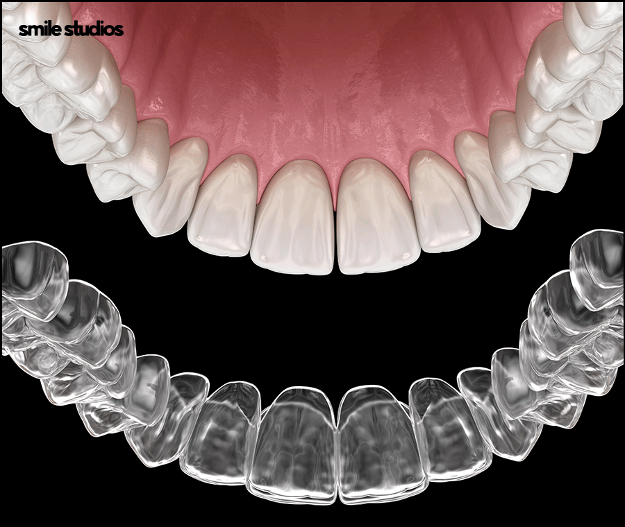 돌출입 인비절라인 기간, 과정, 개선 효과 관련 이미지 7