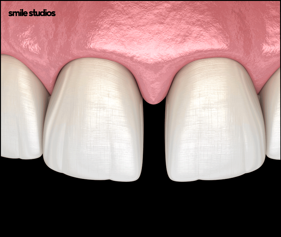 강남 신사역 치과 앞니 벌어짐 교정vs라미네이트 관련 이미지 10