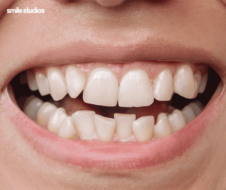 투명교정후기 알아본다면 함께 꼭 확인해야 할 2가지 관련 이미지 5