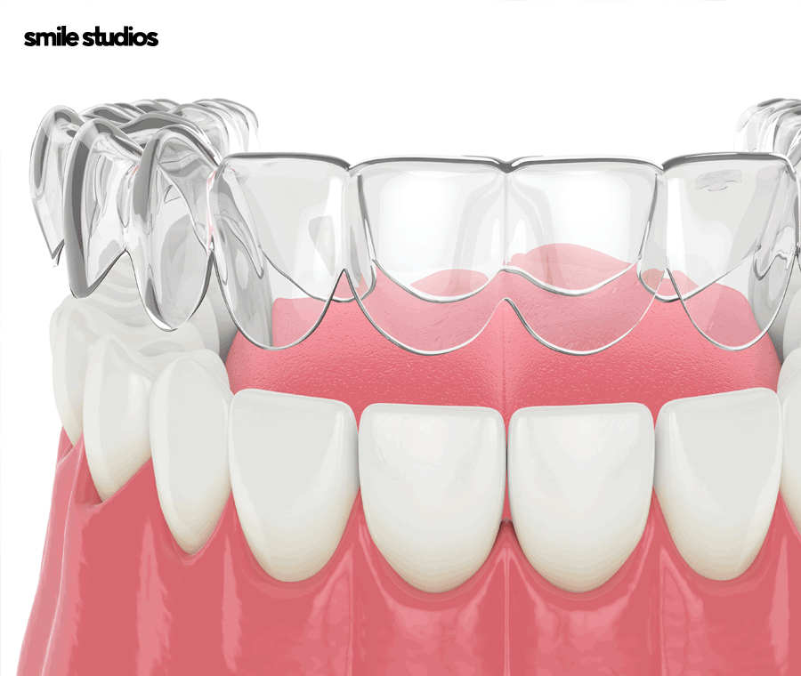압구정 교정치과 인비절라인, 나노라이너 선택 기준 관련 이미지 5