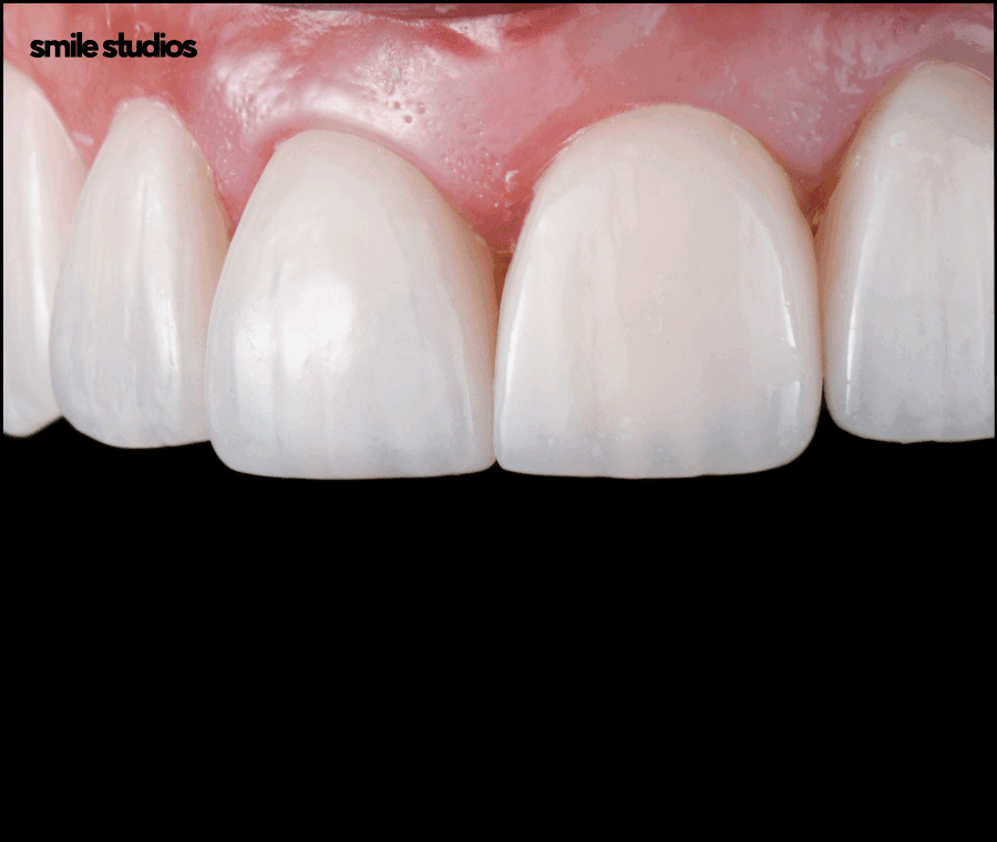 왜소치라미네이트 심미성 개선 효과, 필요성 관련 이미지 9