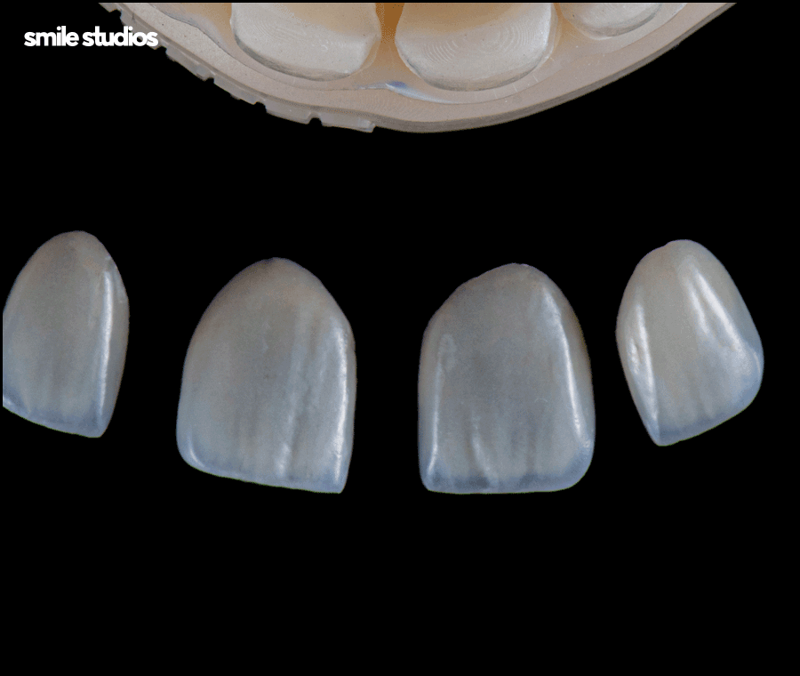 앞니깨짐 치료, 라미네이트 수복 여부, 효과 관련 이미지 5