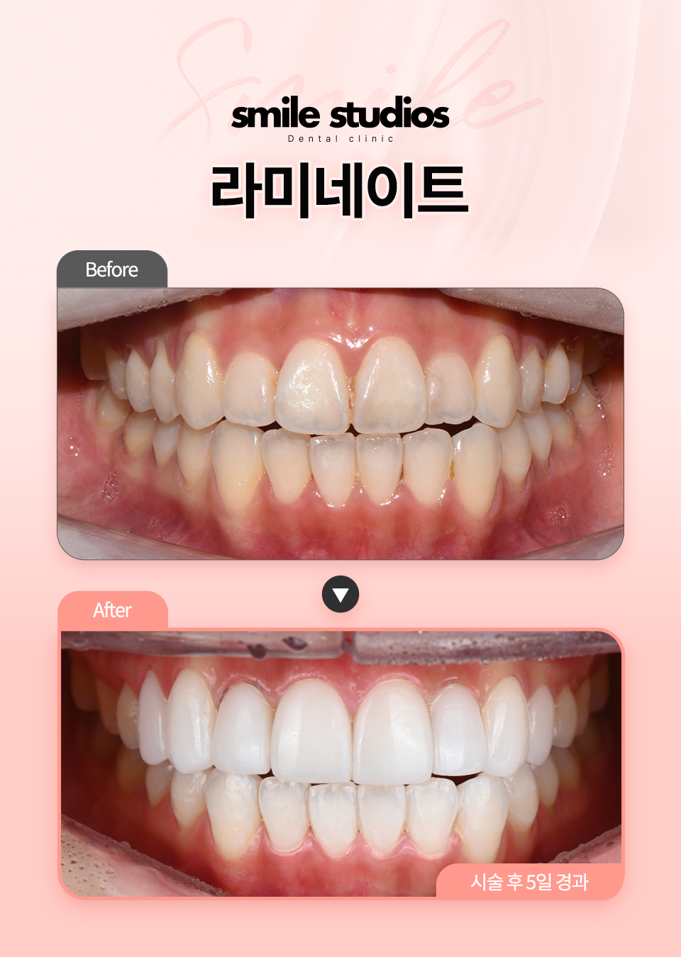 서울라미네이트, 후회 없는 선택 위한 결정적 차이! 관련 이미지 7