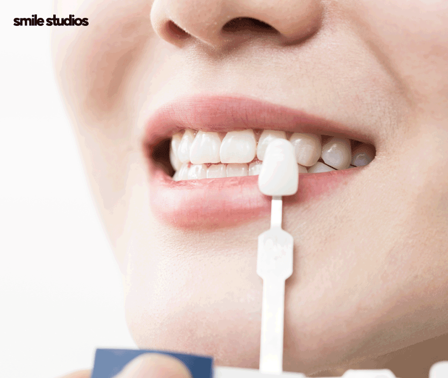 압구정 라미네이트 성공적인 결과를 만드는 핵심은? 관련 이미지 7