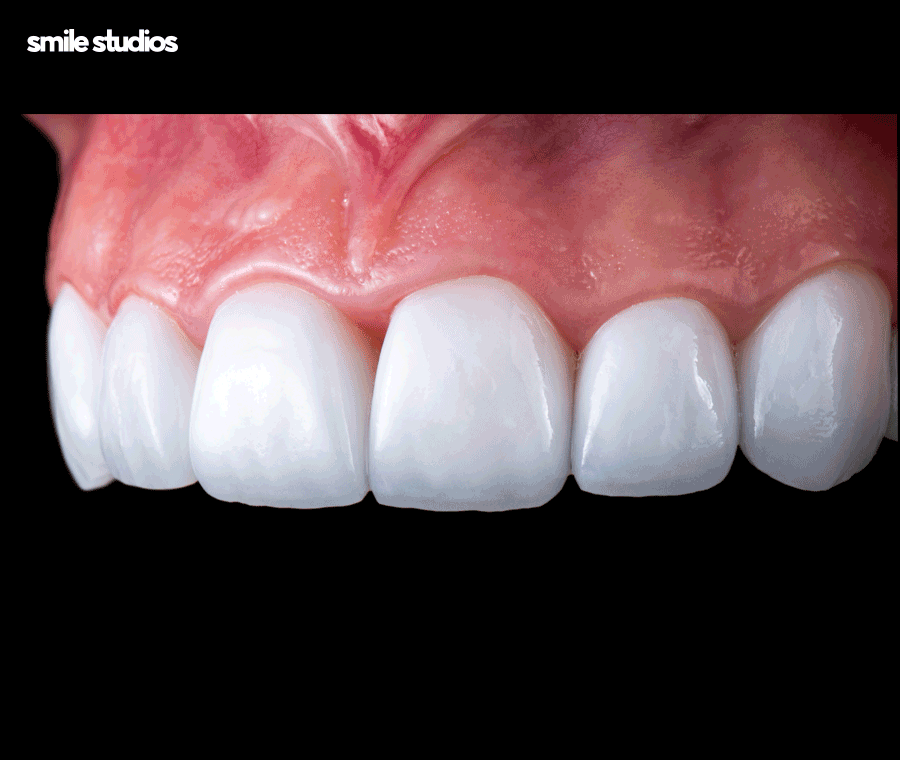 김영경 원장이 전하는 무삭제 라미네이트 A to Z 관련 이미지 2