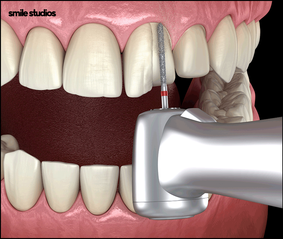 앞니무삭제라미네이트 핵심이 되는 사항은? 관련 이미지 7