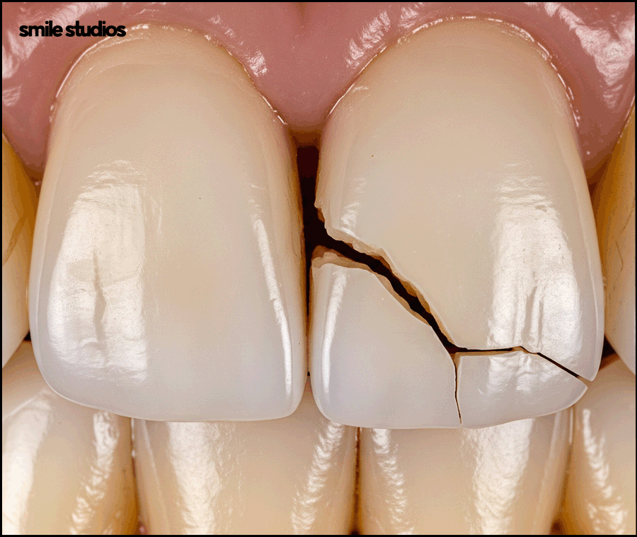 앞니 크랙 금간 치아, 빠른 수복 방법 알아보기 관련 이미지 6