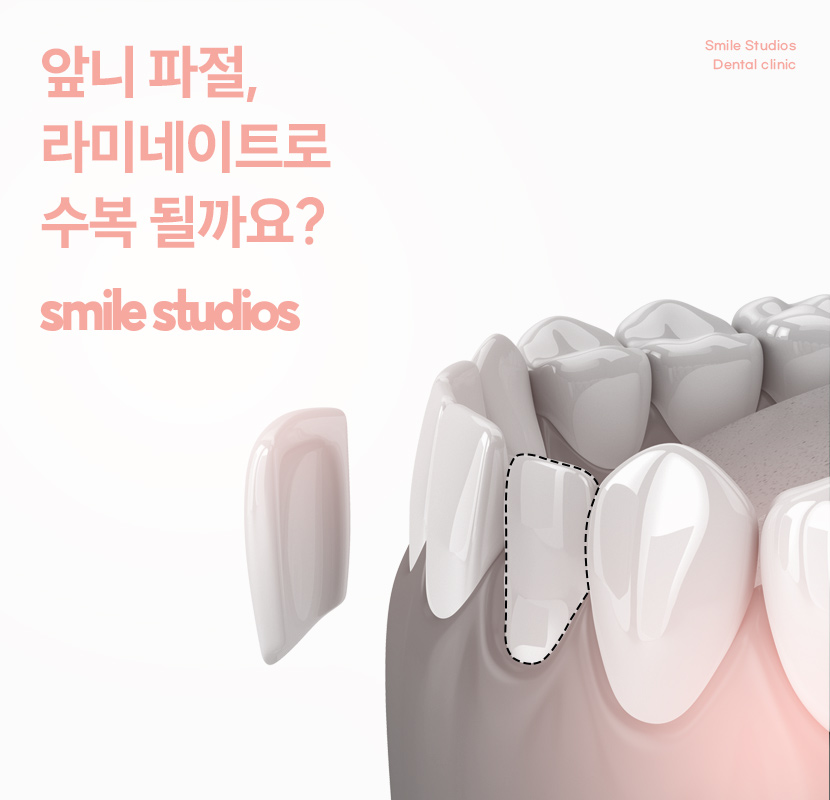 앞니깨짐 치료, 라미네이트 수복 여부, 효과 관련 이미지 1