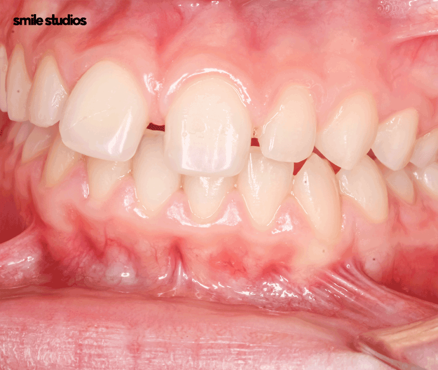 부정교합 치아교정 비용 다른 이유, 함께 체크할 사항 관련 이미지 10