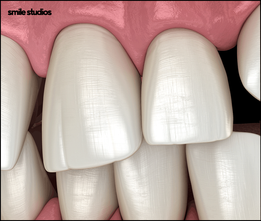 왜소치라미네이트 심미성 개선 효과, 필요성 관련 이미지 3