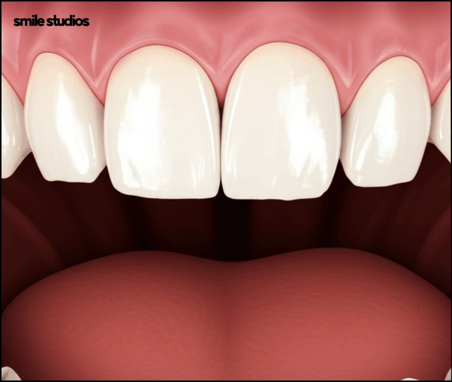 치아반점치 흰얼룩 발생하는 원인, 회복 방법 관련 이미지 4