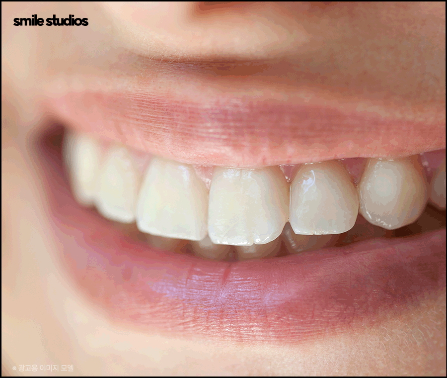 과개교합 교정을 위한 나노라이너 특징 총 정리 관련 이미지 10